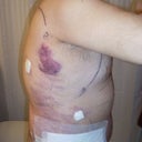 After -side (1 day post-op)