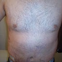After -front (4 days post-op)