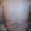 After -back (4 days post-op)
