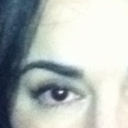 Rt eye.  Pulled down at outer corner.My "sad eye" White show below iris. Couldn't close eye properly.