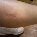 No change to spider veins after 4 weeks