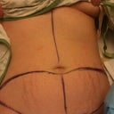 Morning of surgery!