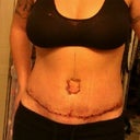 2 days post op