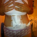 Day 4 Post Op - dressing is still on and I'm swollen but you can see the difference and best of all No Drains!