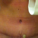 Close up of scar. Stretch mark is the white thing above vertical t. Bandaid covers spitting stitch. I'm happy with it - very straight and low!  6 weeks, 2 days