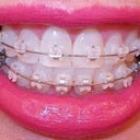 5-6 week follow-up with new wire.  Front teeth are still sitting on neighboring teeth.