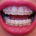 5-6 week follow-up with new wires.  Right bottom teeth are being pull to the right.  I am worried about the right pull.