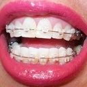 5-6 week follow-up.  You can really see from the side view the front tooth sitting on neighboring tooth.