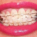 5-6 week follow-up.  From a slight distance people say your teeth are beautiful and already straight. Why braces?