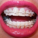 5-6 week follow-up and new wires are pulling teeth in many directions.