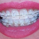 5-6 week follow-up and new wires look so great from a distance. Straight on.