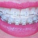 5-6 week follow-up and new wires look so greet from a distance. Smiling downward natural smile. I like how the wire is pushing my teeth down.