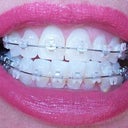5-6 week follow-up and new wires look so greet from a distance. Smiling extra-wide.