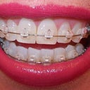 5-6 week follow-up and new wires look so greet from a distance.  The right side is very good.