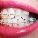 5-6 week follow-up and new wires look so greet from a distance.