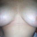 6 wks after revision