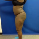 Before BBL side view