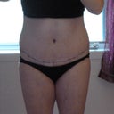 With the scar...You can see it is swollen on the sides