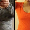 Before and After Breast Implant Removal and Lift with a shirt on. I am loving the results thus far. I am no longer top heavy.