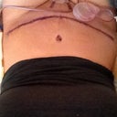 Two days post op