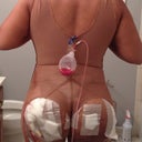 Day 2 post op