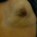 4 weeks later, look at how awful my left breast looks when I raise my arm!