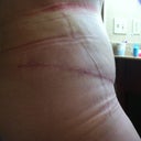 6 weeks po swelling