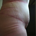 6 weeks po swelling.. The funky lines are from the garment