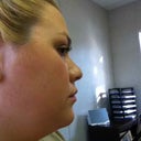 Neck Before Lipo