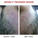 BEFORE FIRST TREATMENT SESSION