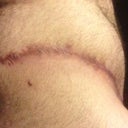 Redness of skin on my sides, still some bumps from what i can only assume are stitches still dissolving.