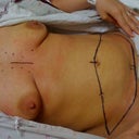 before surgery