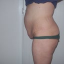 Pre - Op