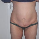 Pre - Op