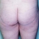 33 Year Old Female Patient 