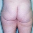 33 Year Old Female Patient 
