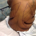 Incision of back folds removed May 17th 2012 Dr. Lindsey New Orleans, LA