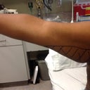 Brachioplasty (wings removed May 17th 2012) Dr. Lindsey New Orleans, LA