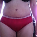 Moles after TT