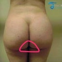 I drew around where the triangle is. I dont know who her doctor is, or postop date.