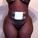 3 days post op "re touch bbl"