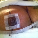 Left breast