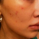 Day after laser facial (no makeup)