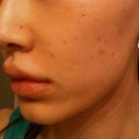 Day after laser facial