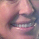 You can really see the ridge under my left eye here. This is 5 months after and 3 injections to dissolve it.