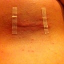 Week 2 righ incision w/rash