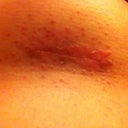 Week 2 left incision rash is worse on this one.