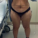 markings before surgery