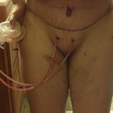 8 days post op half way up drains still in