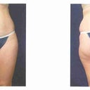 BEFORE SURGERY: Tummy / Flanks / Thighs